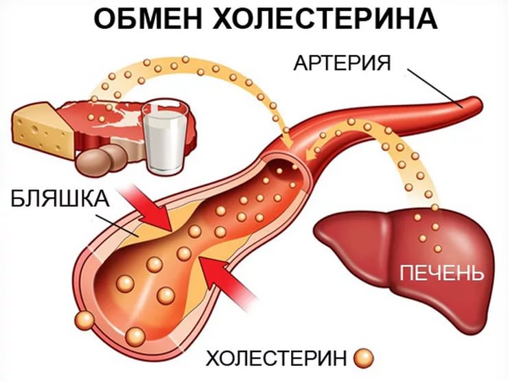 Атеросклероз сосудов кишечника