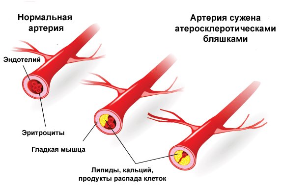 Атеросклероз полового члена