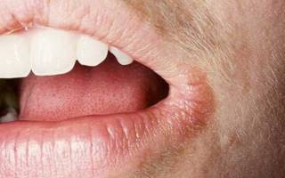 Трещины на губах от вредных привычек