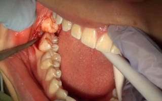 Разрез при удалении зуба