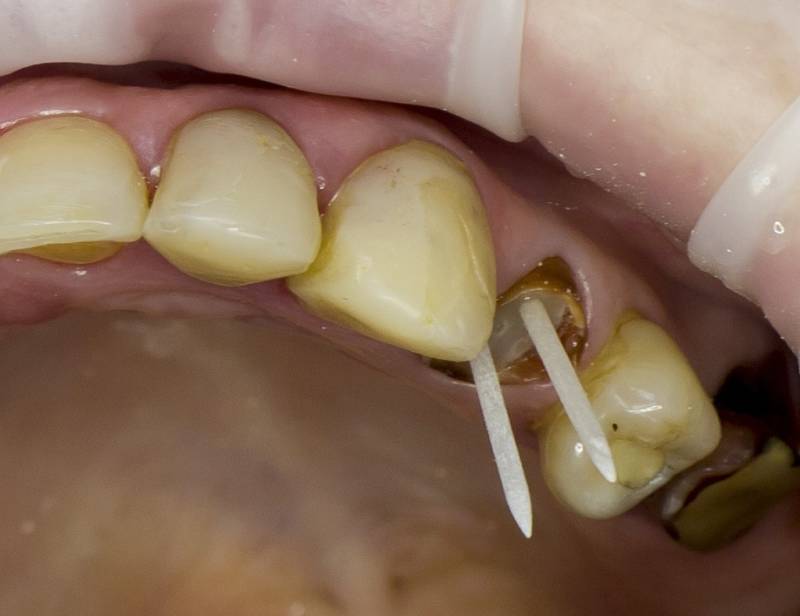 Протезирование разрушенного зуба сохранившего корни
