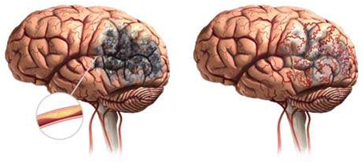 Brain 70. Поражение головного мозга. Поражение сосудов головного мозга.