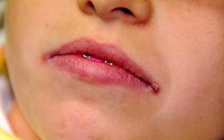 Травмы в уголках губ