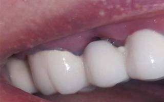 Болит зуб под коронкой