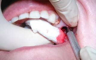 Удаление зубного корня