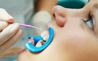 Фторирование зубов ребенку