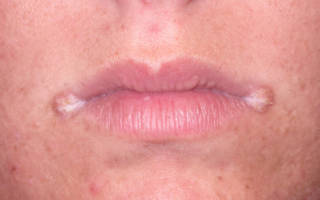 Грибковые поражения в уголках губ
