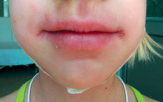 Трещины в уголках губ у ребенка