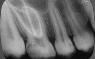 Зубные каналы на рентгене