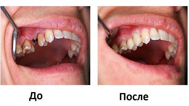 Имплантация разрушенного зуба