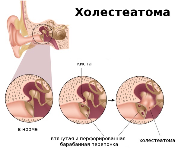 Холестеатома уха