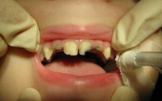 Раскрошенные зубы у ребенка