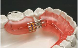 Несъёмные пластины для выравнивания зубов