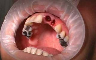 Кровяной сгусток после удаление зуба