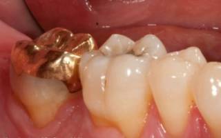 Металлическая вкладка на зуб