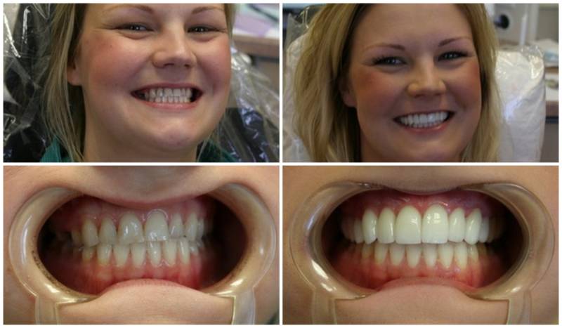 реставрация зубов - результат