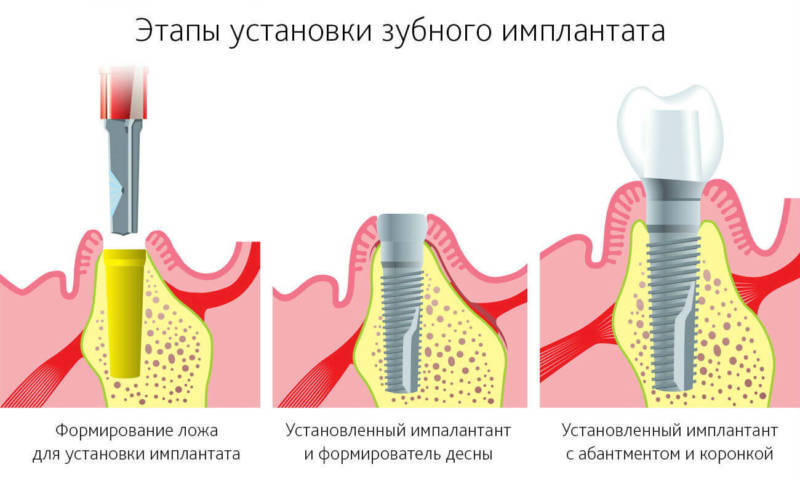 Этапы установки зубного импланта