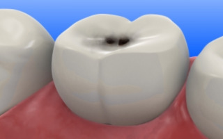 Черная точка на жевательном зубе