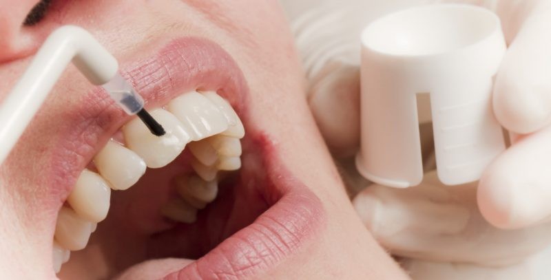 Процесс покрытия зубов фторлаком