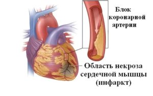 Инфаркт миокарды