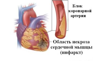 Инфаркта миокарда