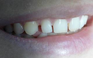 Пространство между зубами