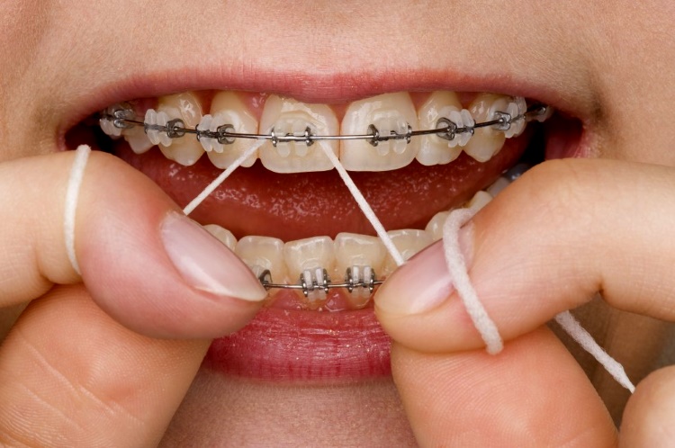 Чистка зубов зубной нитью при наличии брекетов
