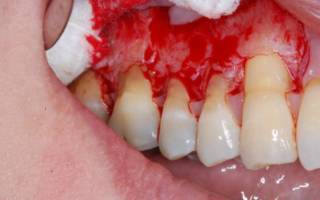 Хронический периодонтит зубов