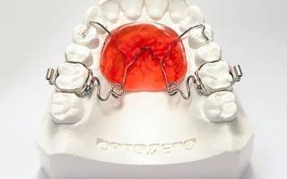 Ортодонтический аппарат для исправления прикуса