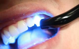 Чистка зубов лазером