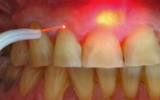 Лазерное лечение кисты зуба