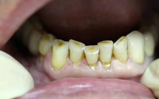 Повышенная стираемость зубов