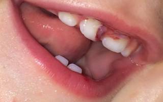 Оголившиеся зубы