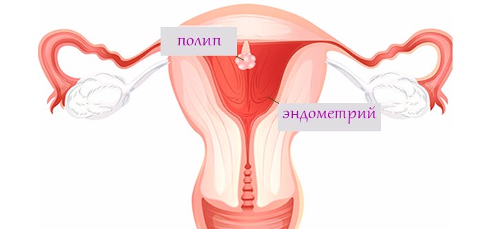 Полипы эндометрия в матке