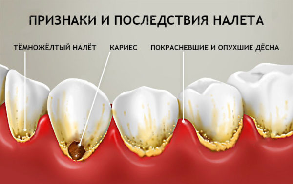 Признаки и последствия зубного налета