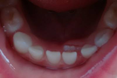 Прорезывание постоянных зубов у ребенка