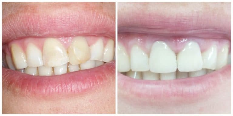 Пломбирование передних зубов до и после