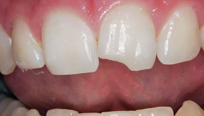 Скол переднего зуба