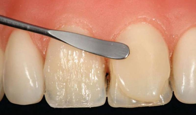 Реставрация зубов композитом