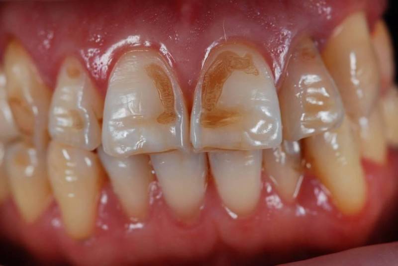 Гипоплазия зубной эмали у детей фото