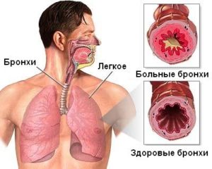 Заболевание дыхательной системы