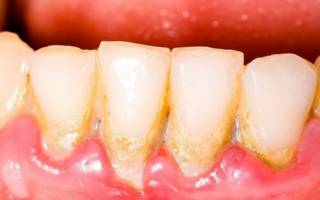 Зубной камень на нижних зубах