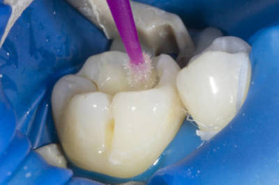 Адгезивная реставрация зуба