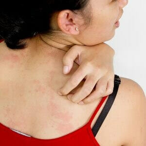 Аллергия и зуд