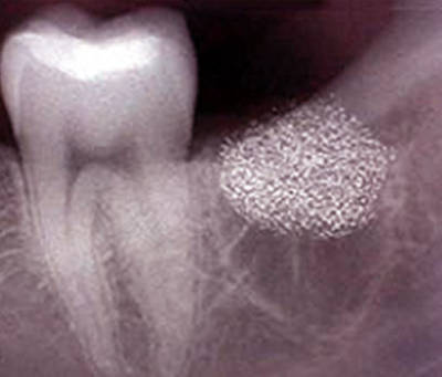 Альвеолит зуба на рентгене