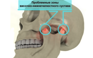 Проблемные зоны челюстного сустава