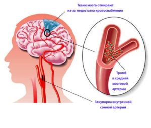 Атеросклероз магистральных артерий головного мозга