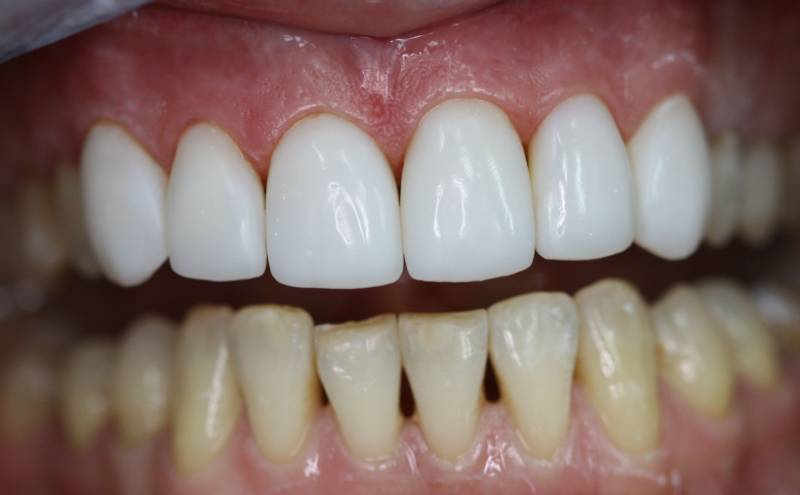 Белая эмаль зубов
