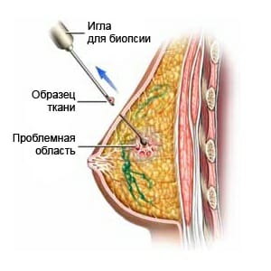 Пункция молочной железы
