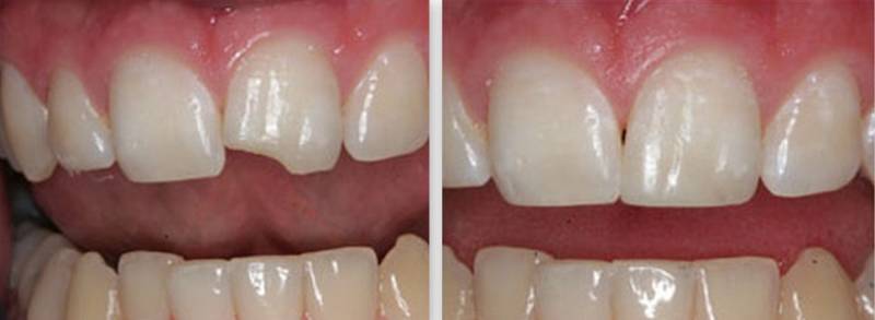 До и после наращивания передних зубов